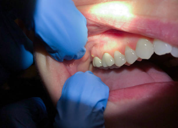 Best Emergency Treatment for Oral Infections in Hermantown, MN
